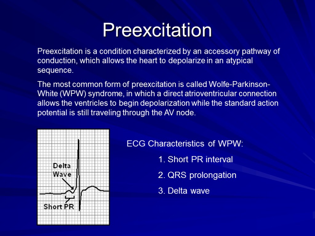 Preexcitation ECG Characteristics of WPW: 1. Short PR interval 2. QRS prolongation 3. Delta